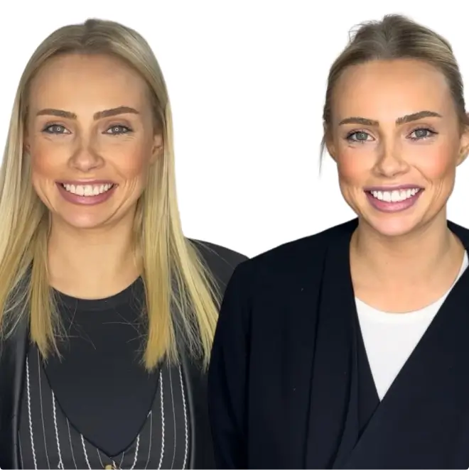 Before and after smile makeover photos of female patient at D'vine Smiles Dental