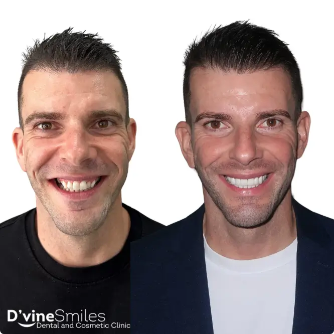 Before and after smile makeover photos of male patient at D'vine Smiles Dental