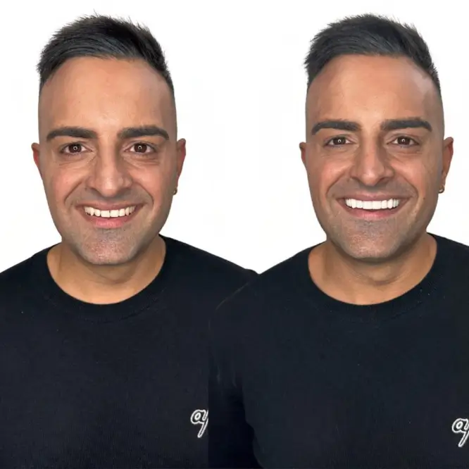 Before and after smile makeover photos of male patient at D'vine Smiles Dental